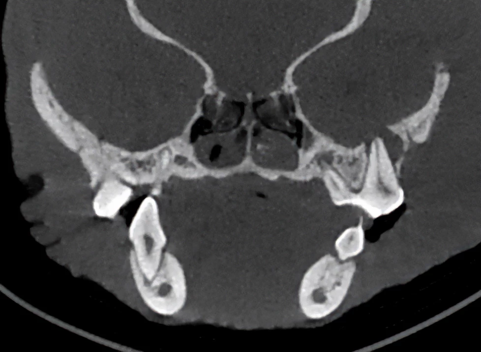 CBCT image